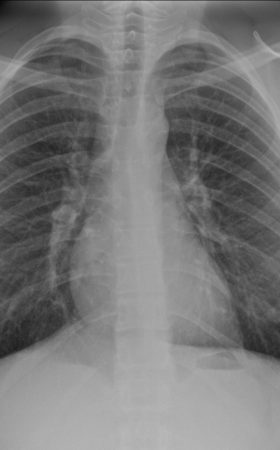 Röntgen Lunge